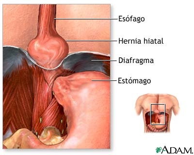 Hernia gastrica transhiatala